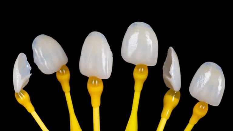 انواع لمینت دندان