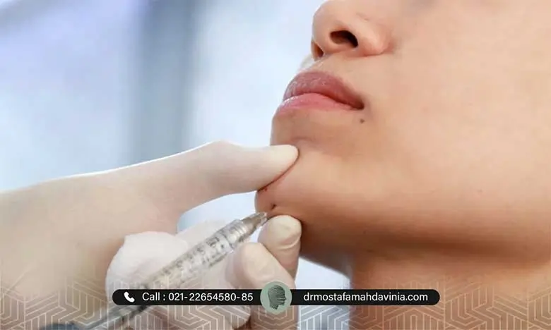 تزریق فیلر چانه
